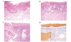 Carcinome cervical in situ