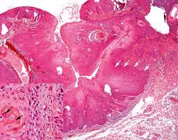 Carcinome cervical in situ