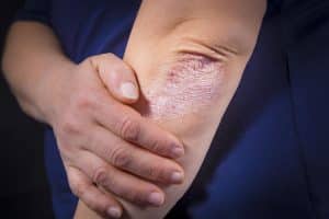 Causes du psoriasis