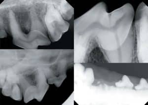 Radiographie dentaire