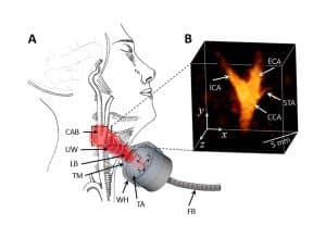 Sténose carotidienne