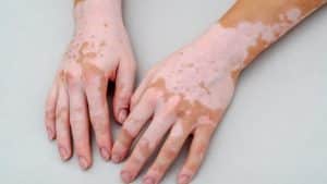 Vitiligo