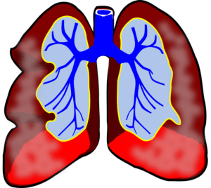 bronchopneumopathie chronique obstructive ou BPCO