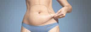 Zone coolsculpting