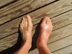 traiter naturellement l’hallux valgus