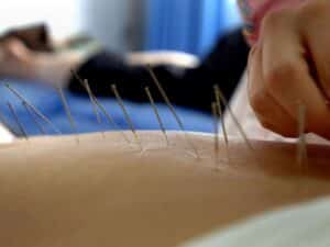 l'acupuncture