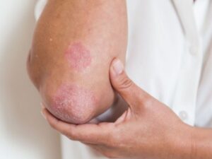 le psoriasis