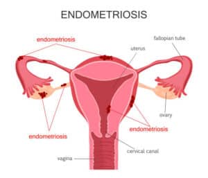 Endométriose et Kystes Ovariens